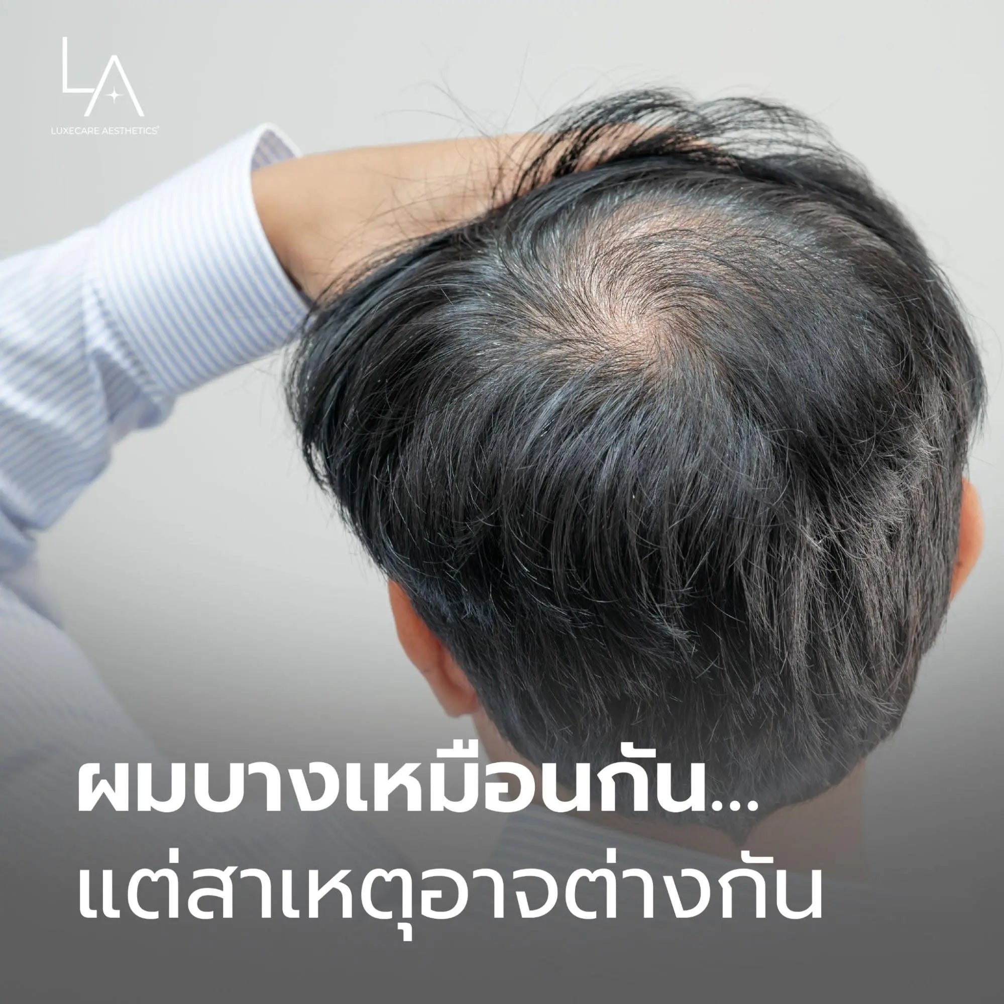 ผมบางเหมือนกัน…แต่สาเหตุอาจไม่เหมือนกัน