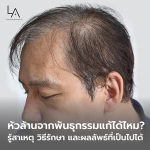 หัวล้านจากพันธุกรรมแก้ได้ไหม? รู้สาเหตุ วิธีรักษา และผลลัพธ์ที่เป็นไปได้