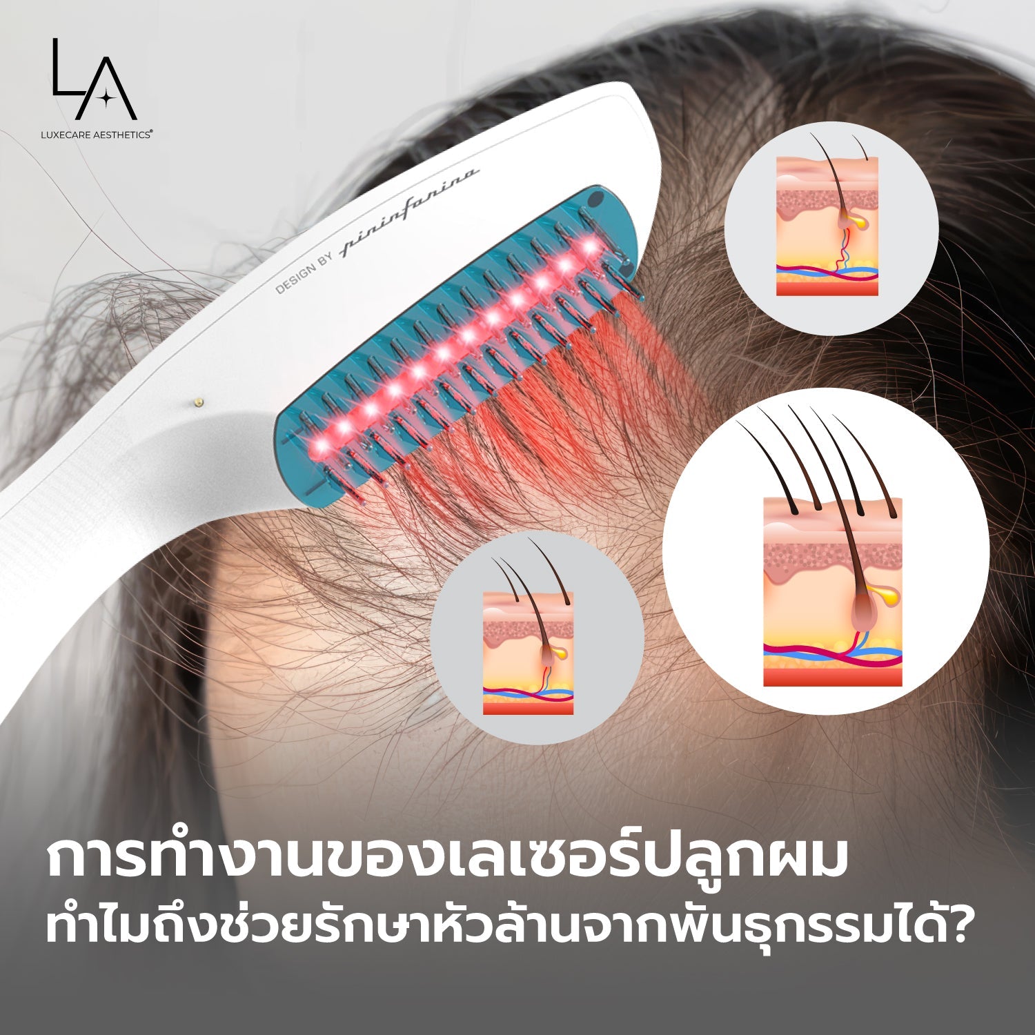 การทำงานของเลเซอร์ปลูกผม ทำไมถึงช่วยรักษาหัวล้านจากพันธุกรรมได้?
